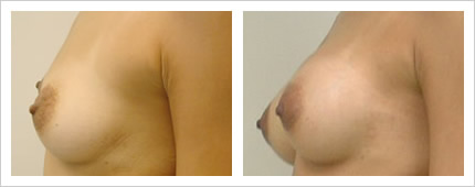 バスト脂肪注入の症例写真2-2