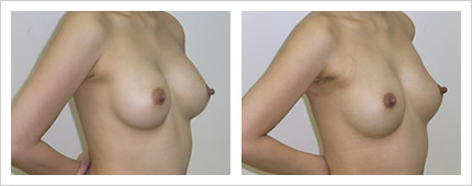 バスト脂肪注入の症例写真3-2