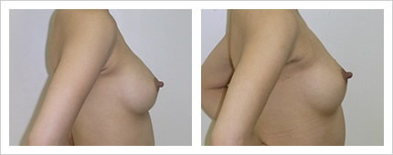 バスト脂肪注入の症例写真3-3