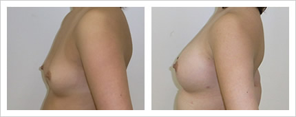 バスト脂肪注入の症例写真5-3